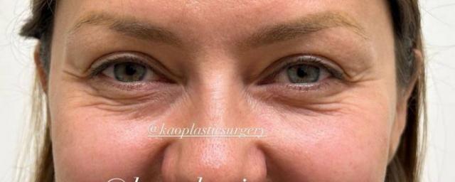 Хирург показал фото Виктории Бони перед операцией по изменению разреза глаз